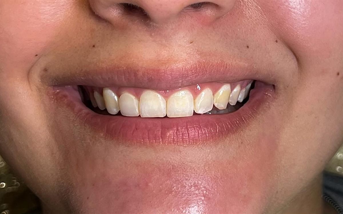 Antes: Gengivoplastia, clareamento e facetas em resina