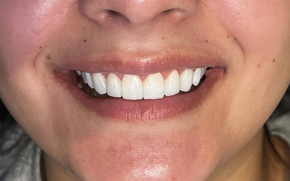Depois: Gengivoplastia, clareamento e facetas em resina